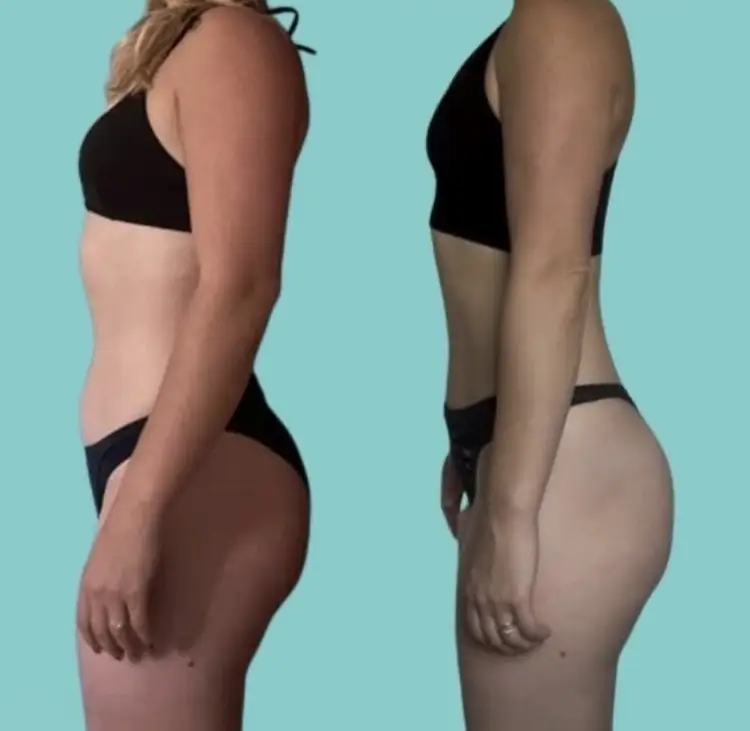 Before and after of a client: both sides show a side view against a teal background, left in a black crop top and dark briefs with hair tied up, right in a black crop top and dark thong.